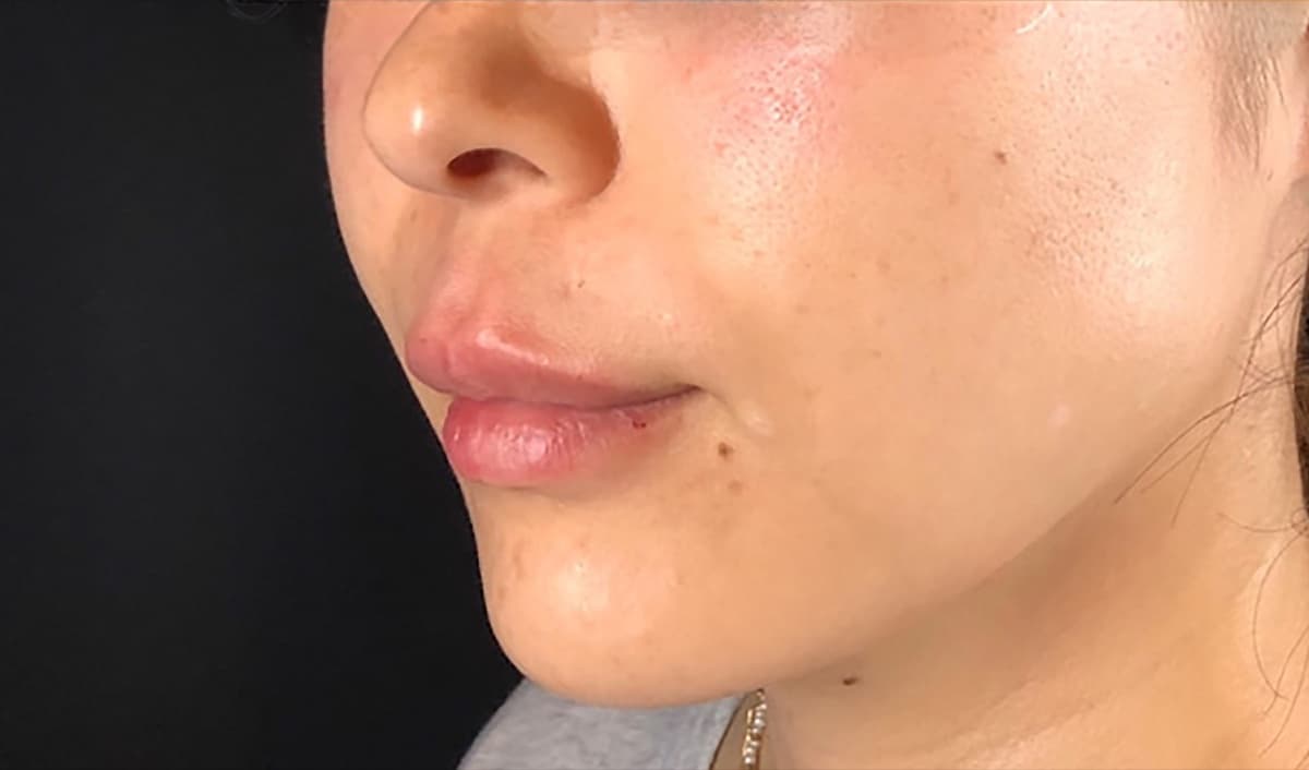 Philtrum Shortening Hyaluronic Acid Injection After