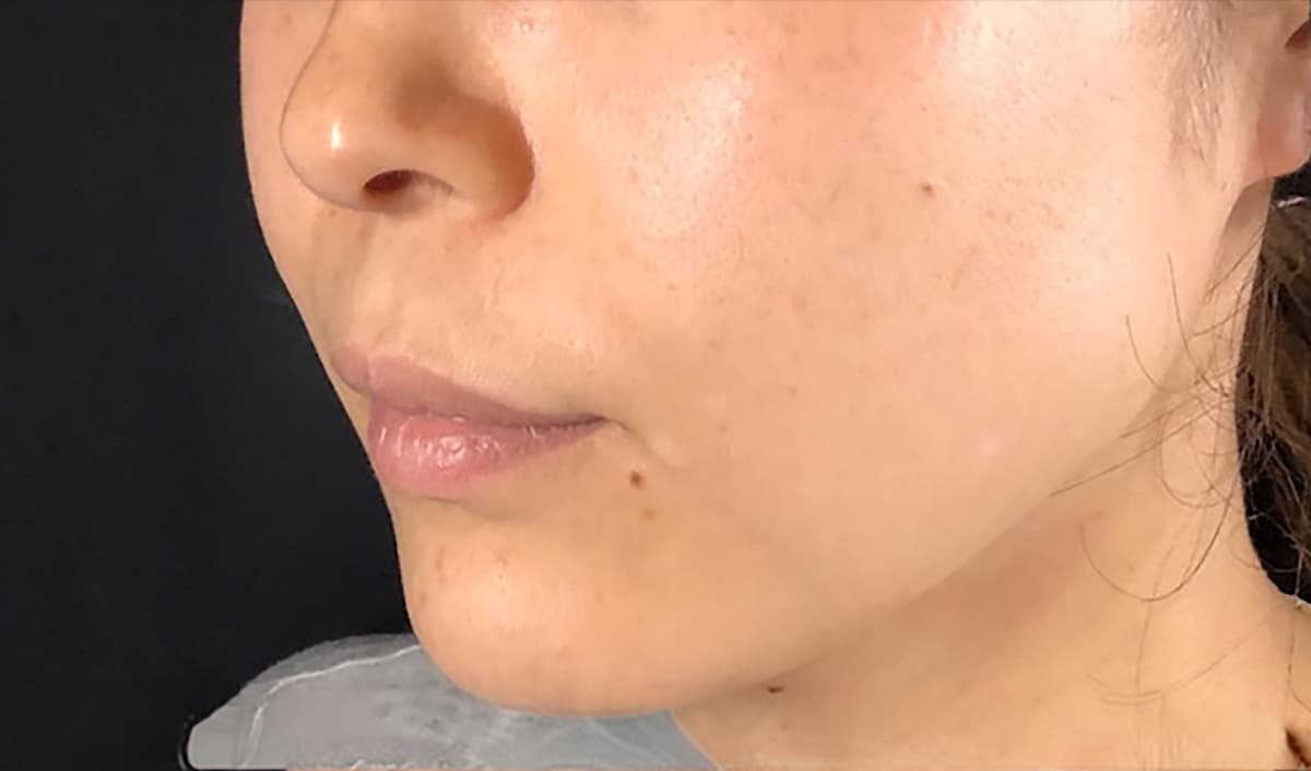 Philtrum Shortening Hyaluronic Acid Injection Before