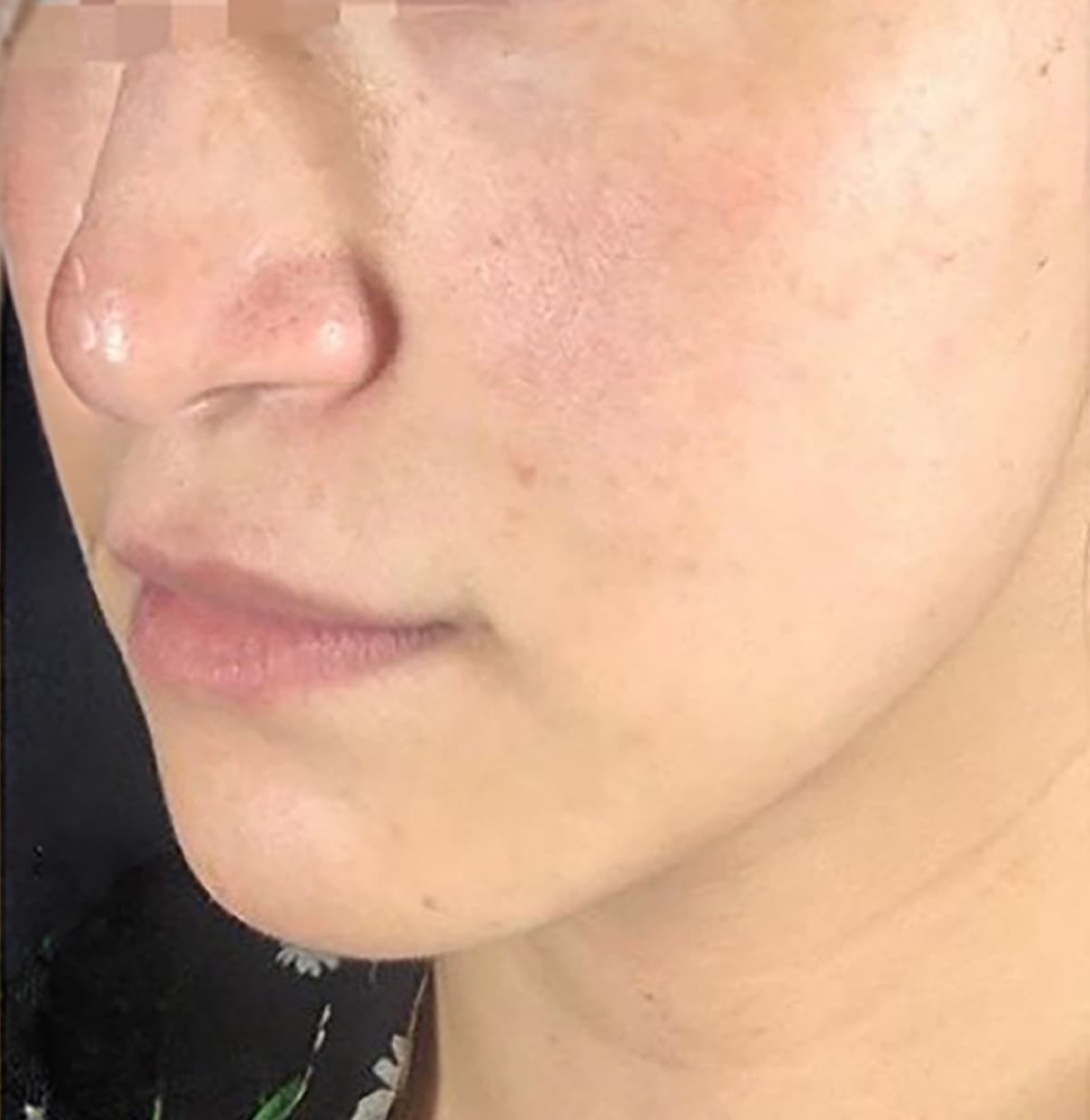 Lumecca (IPL) After