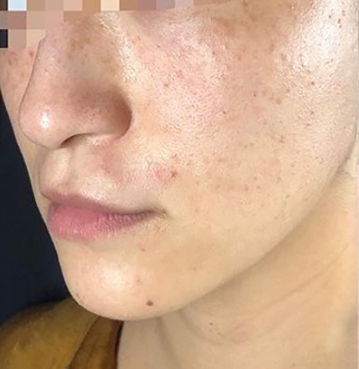 Lumecca (IPL) Before