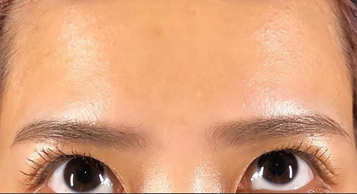 Botox After