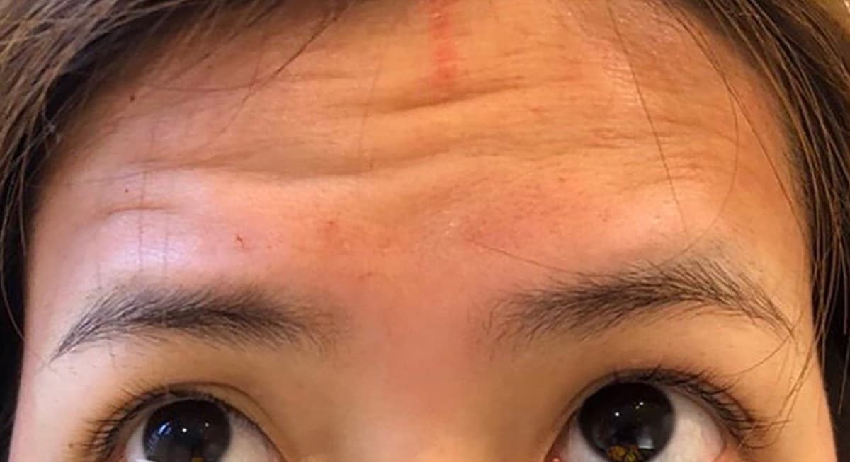 Botox Before