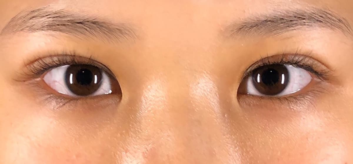Rejuva Eyes Double (Eyelid) After