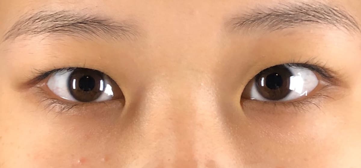 Rejuva Eyes Double (Eyelid) Before