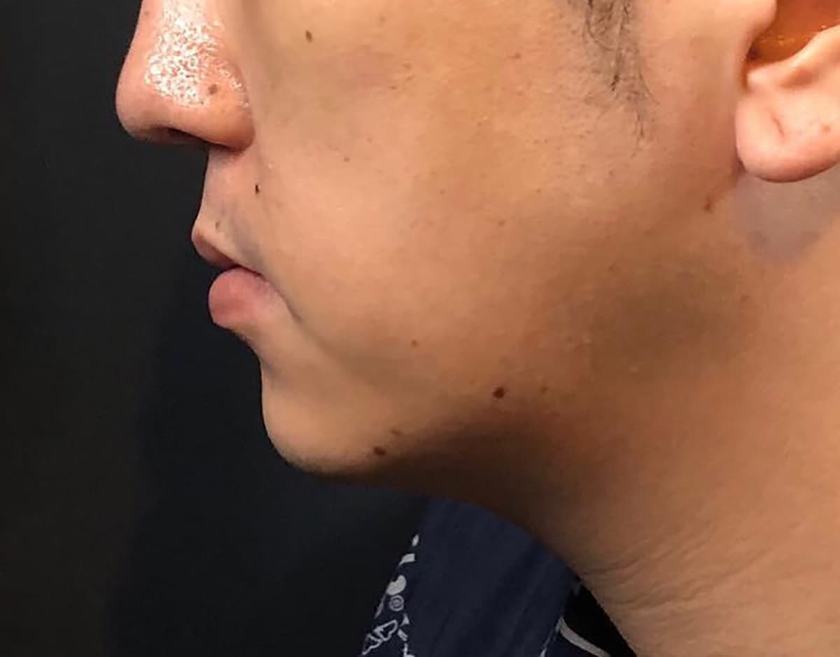 Chin Botox + Chin Filler After