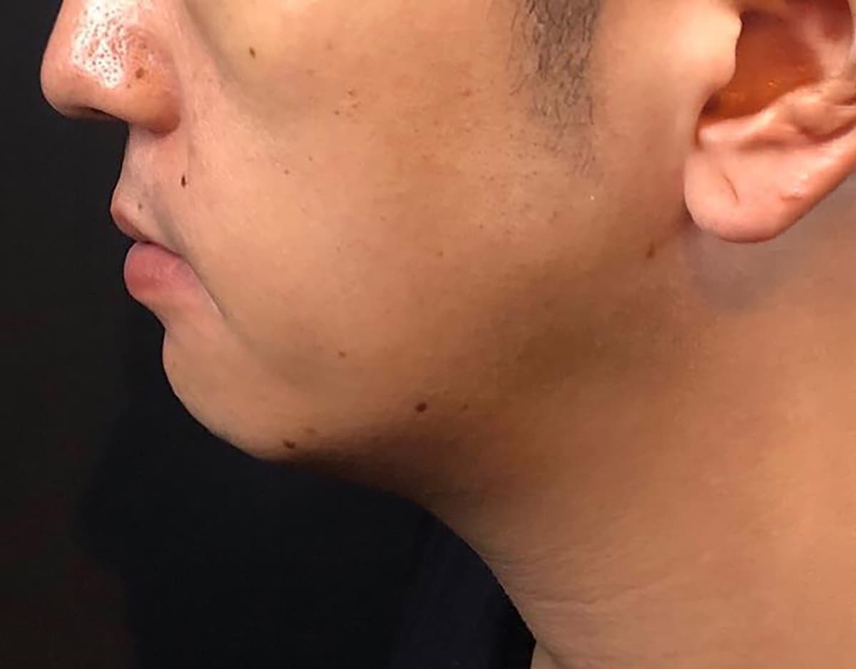 Chin Botox + Chin Filler Before