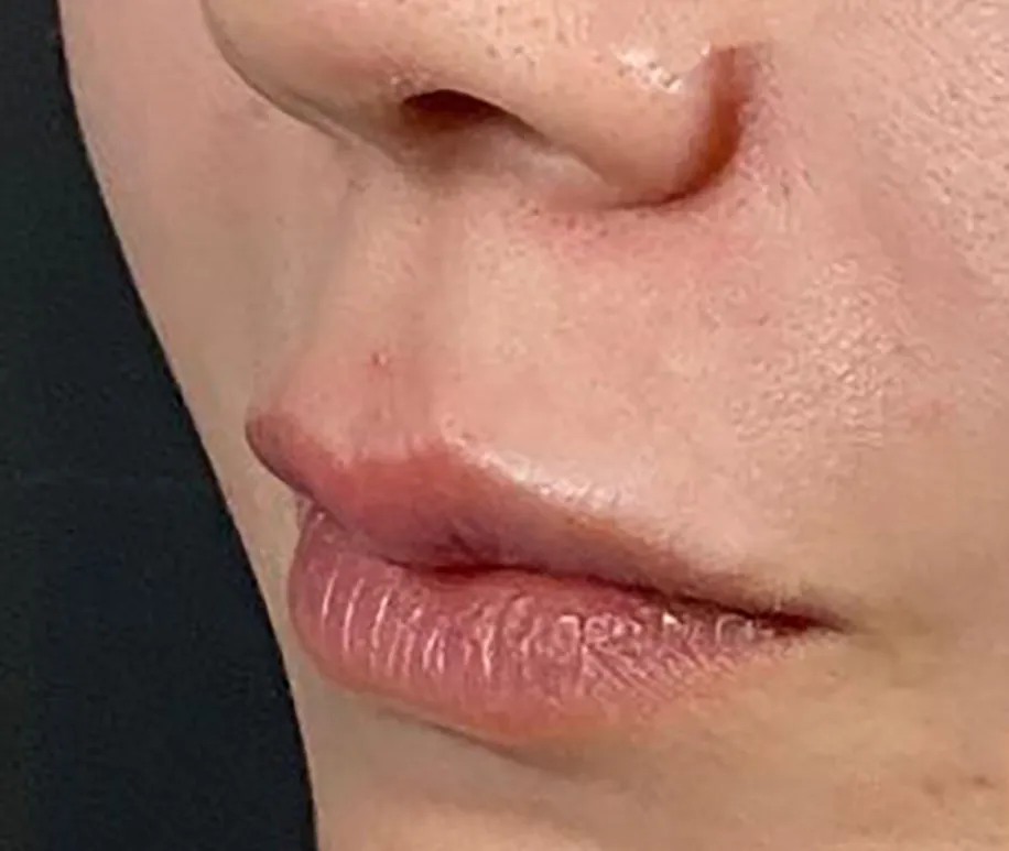 Philtrum Shortening Hyaluronic Acid Injection After