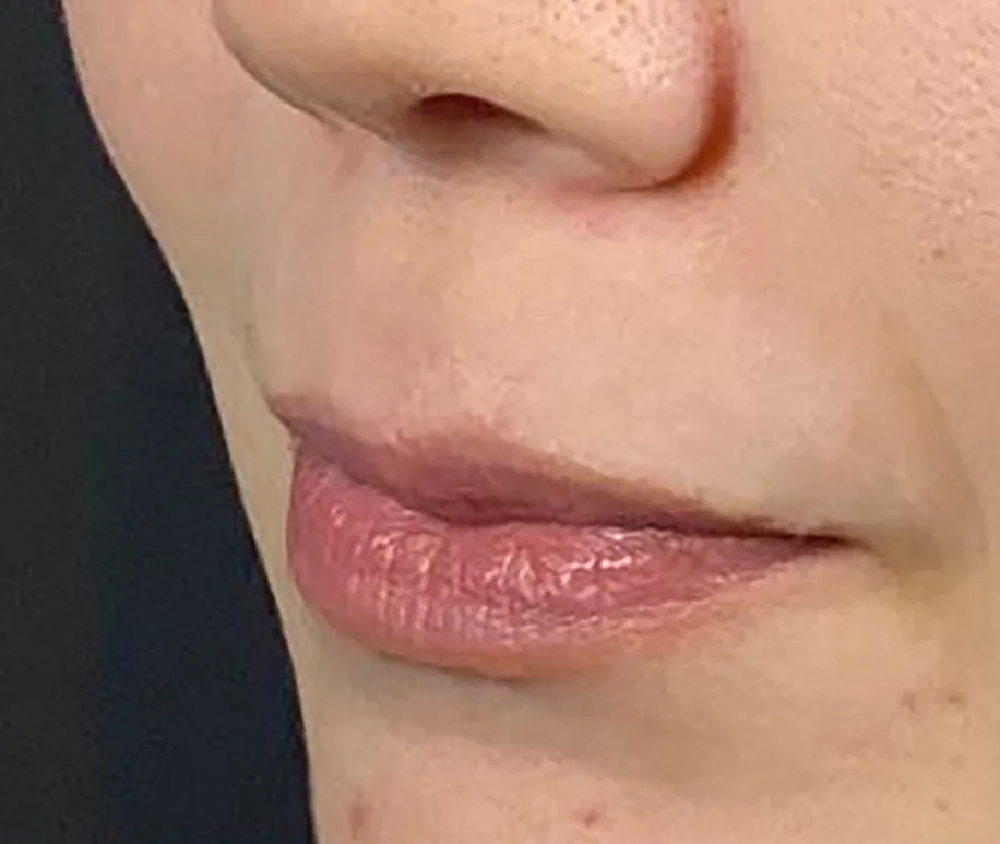 Philtrum Shortening Hyaluronic Acid Injection Before