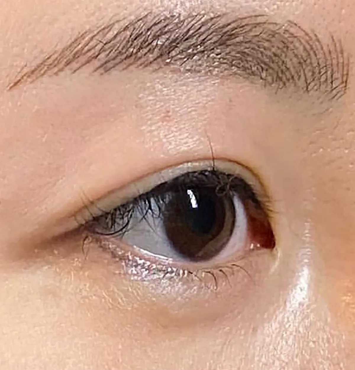 Upper Eyelid Hyaluronic Acid After