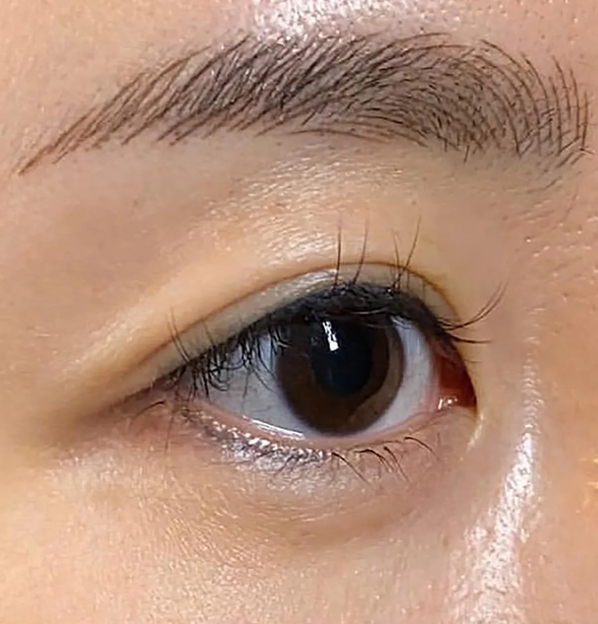Upper Eyelid Hyaluronic Acid Before