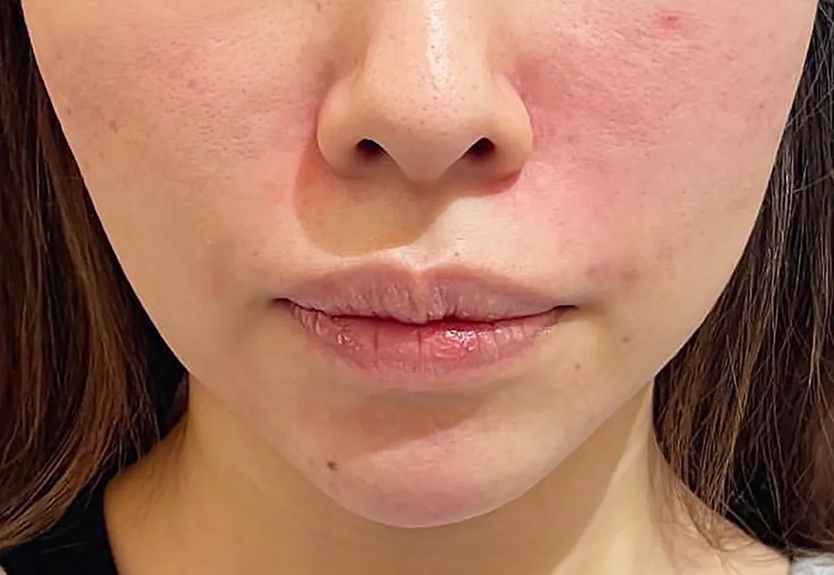 Nasolabial Folds / Chin Hyaluronic Acid Injection After