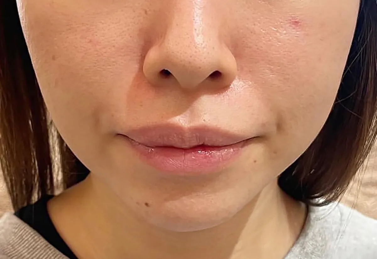 Nasolabial Folds / Chin Hyaluronic Acid Injection Before