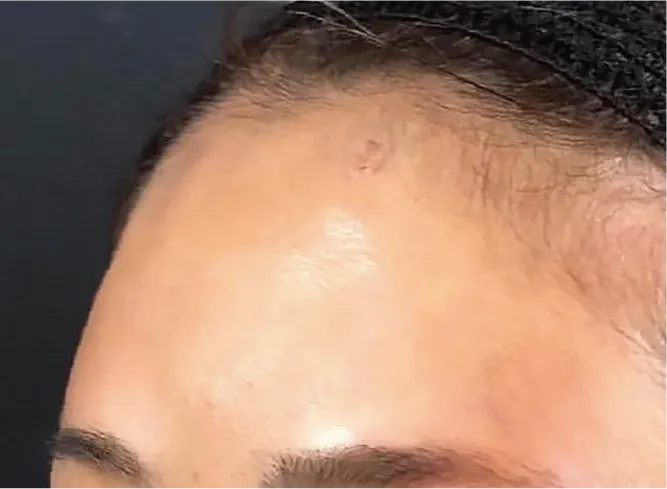 Forehead Hyaluronic Acid After