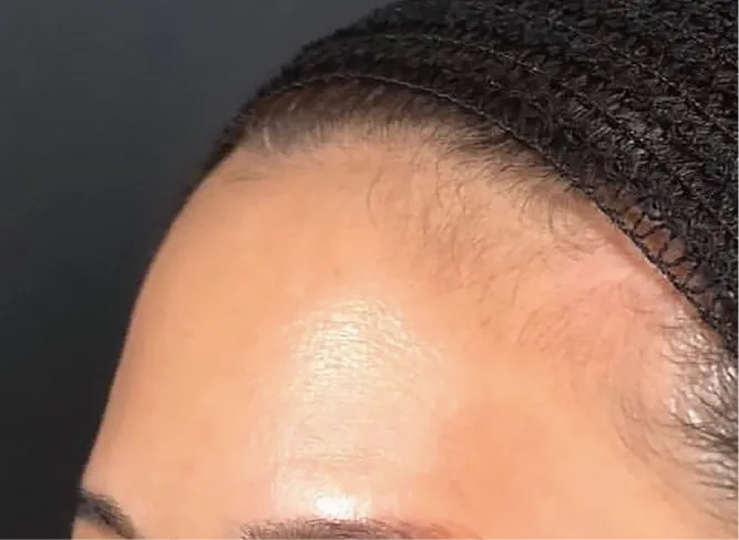 Forehead Hyaluronic Acid Before