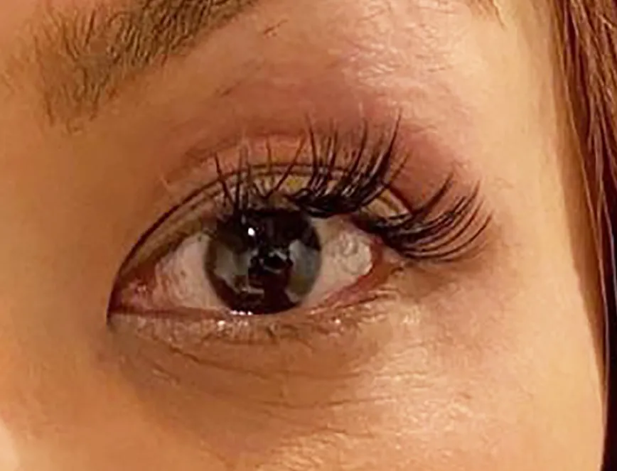 Upper Eyelid Hyaluronic Acid After