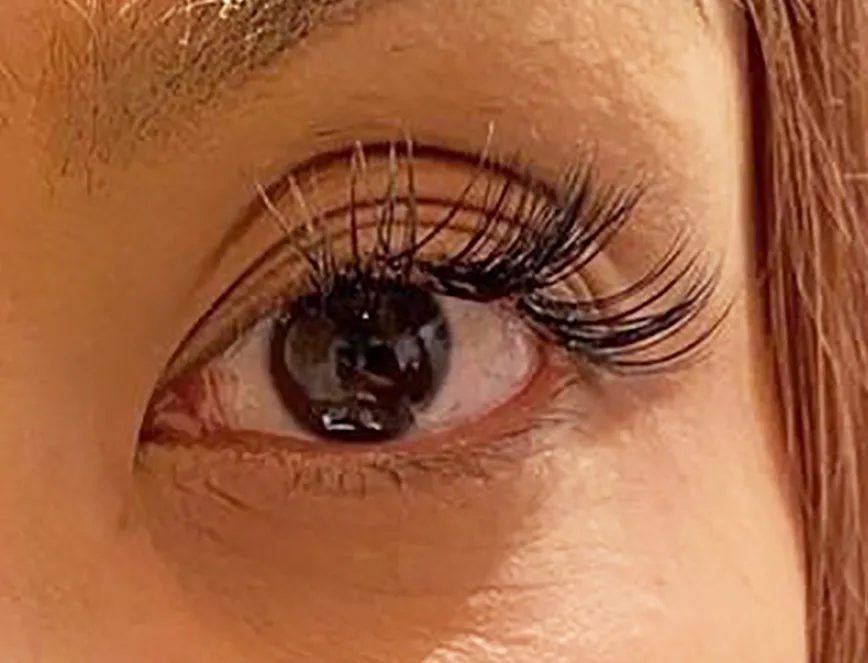 Upper Eyelid Hyaluronic Acid Before