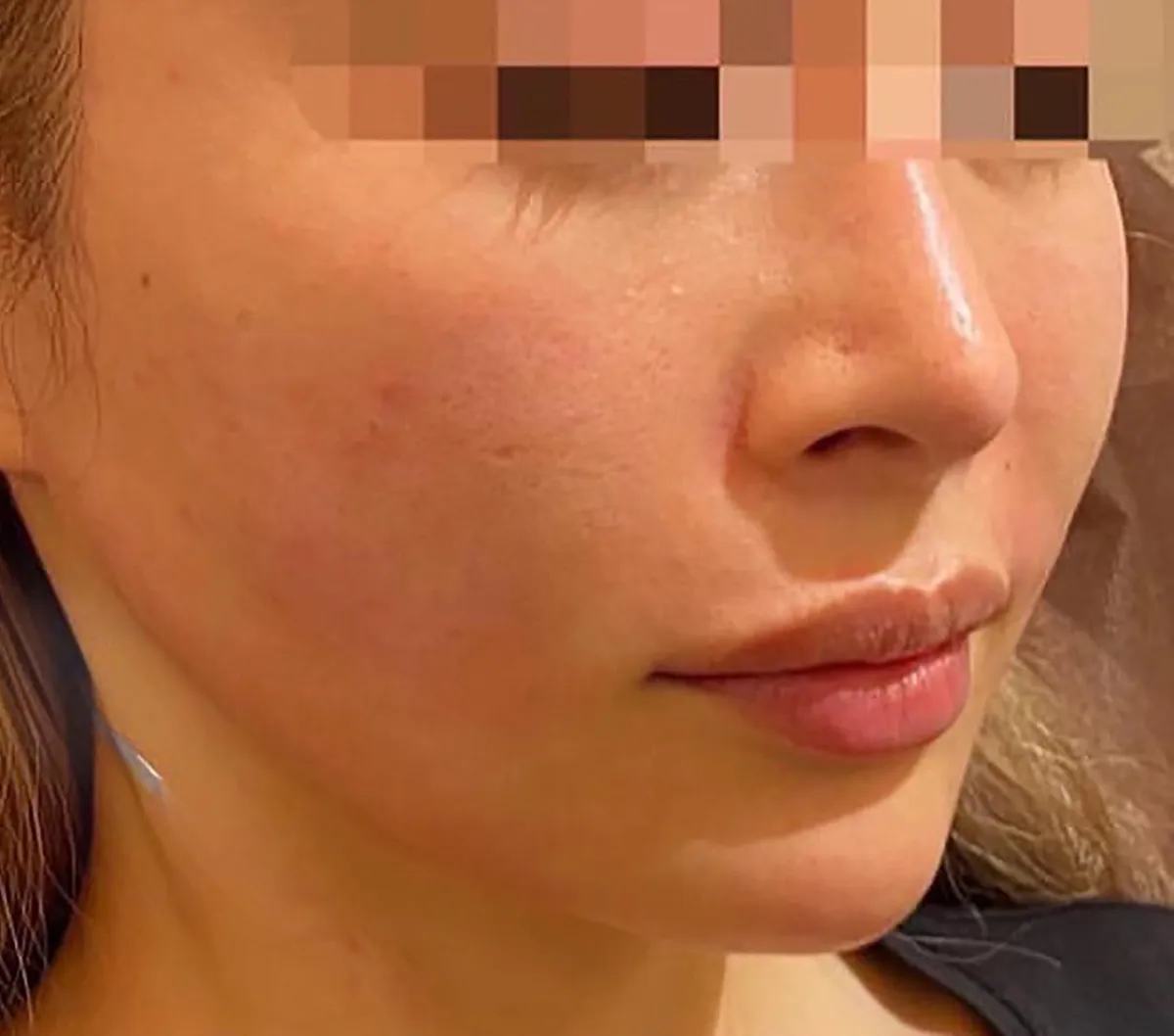 Nasolabial Folds / CheeksHyaluronic Acid Injection After