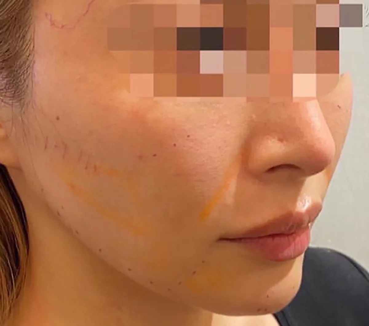 Nasolabial Folds / CheeksHyaluronic Acid Injection Before