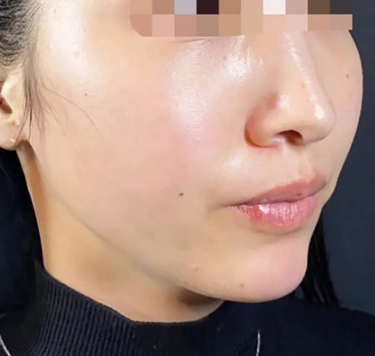 Tesslift Thread Lift After