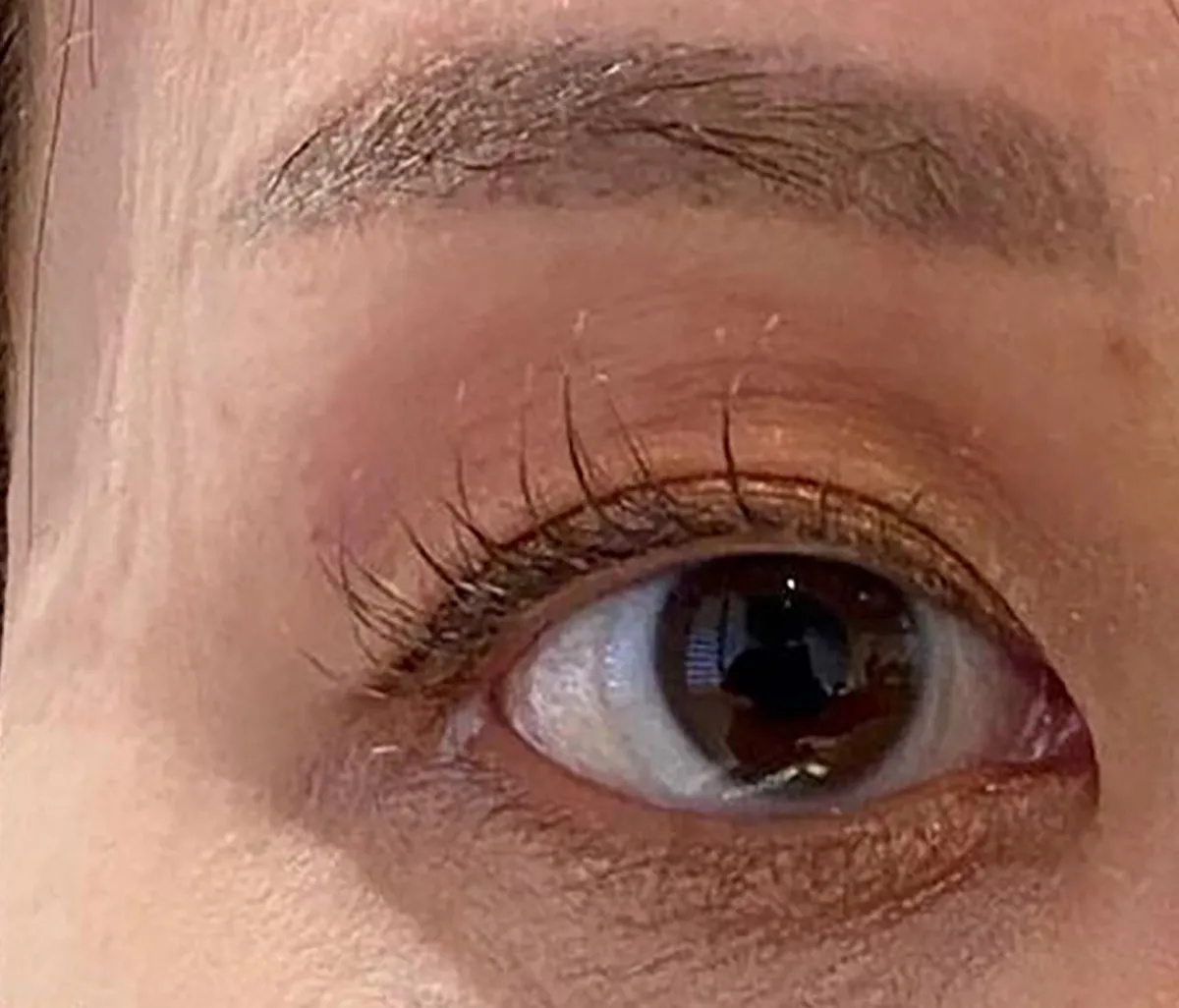 Upper Eyelid Hyaluronic Acid After