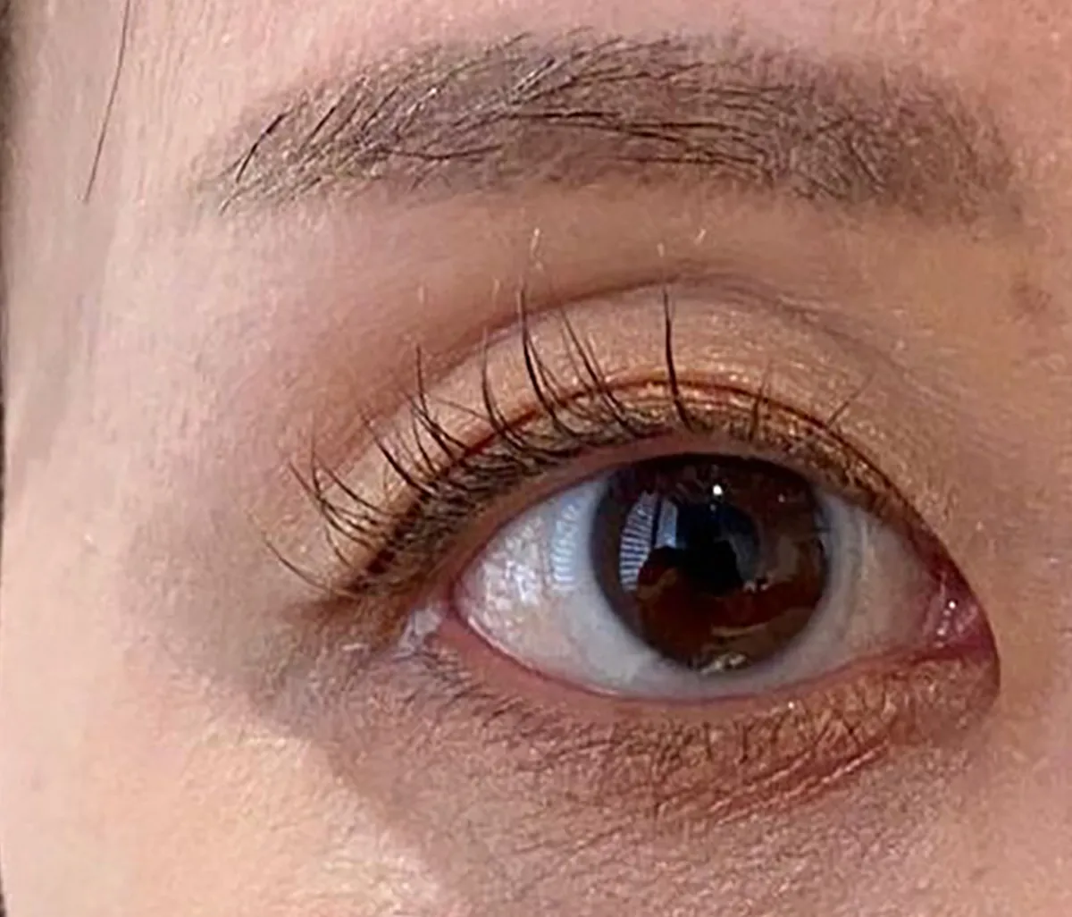 Upper Eyelid Hyaluronic Acid Before