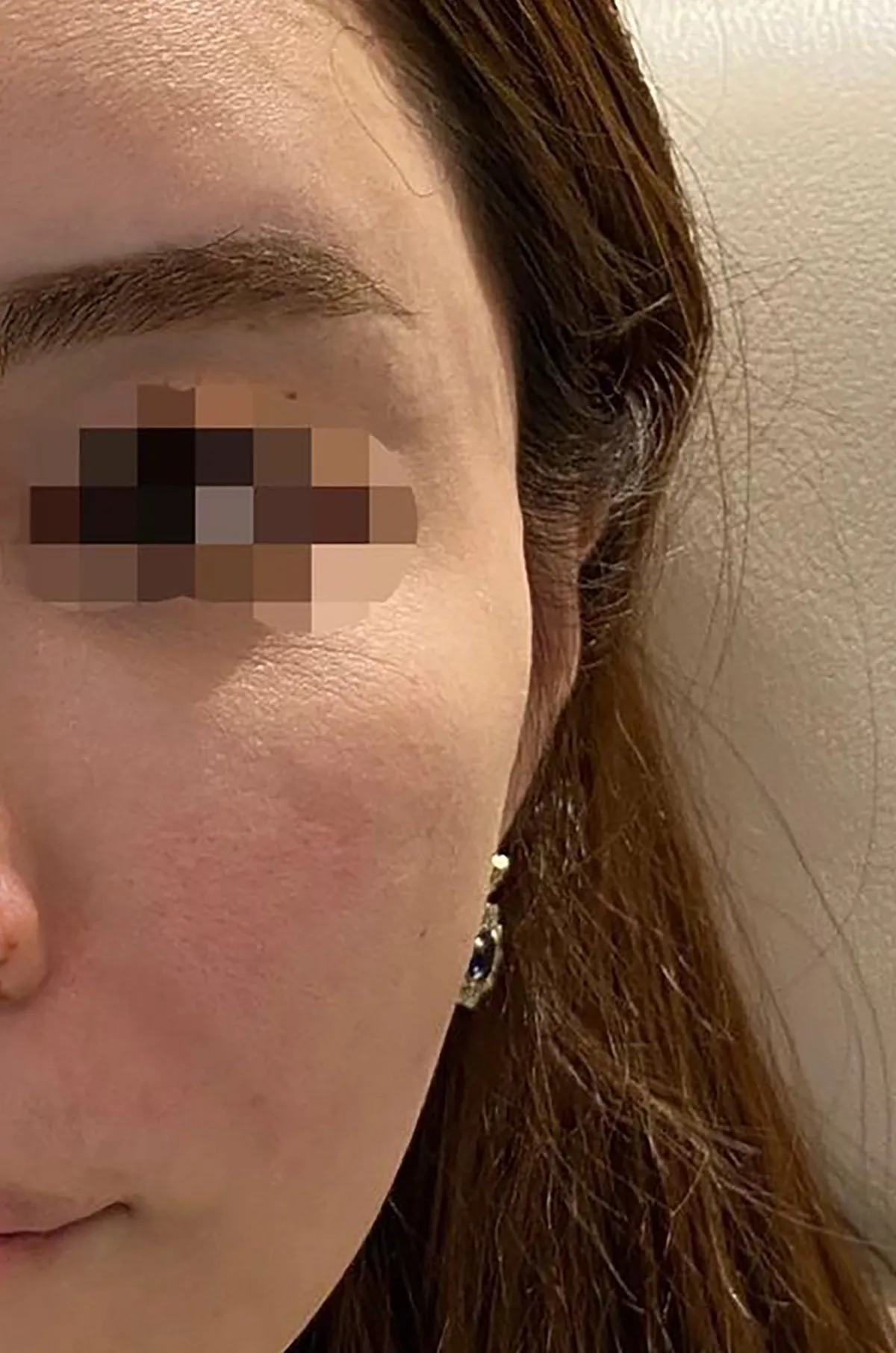 Temples / CheeksHyaluronic Acid Injection After
