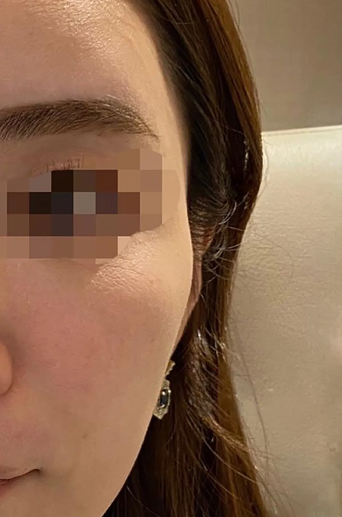 Temples / CheeksHyaluronic Acid Injection Before