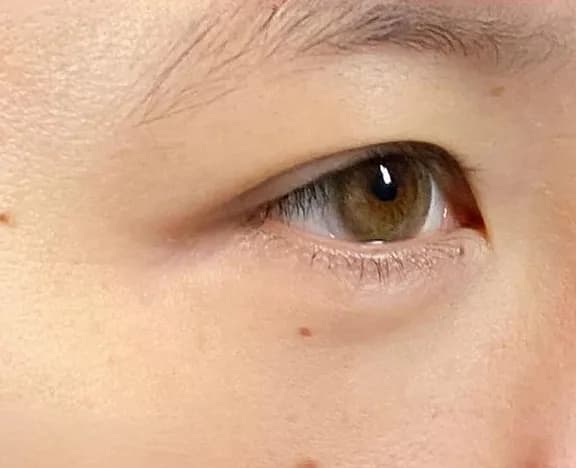 Lower Eyelid Fat Removal Surgery After
