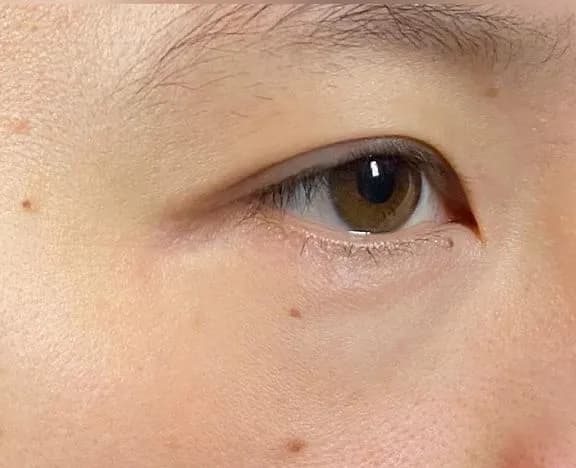 Lower Eyelid Fat Removal Surgery Before