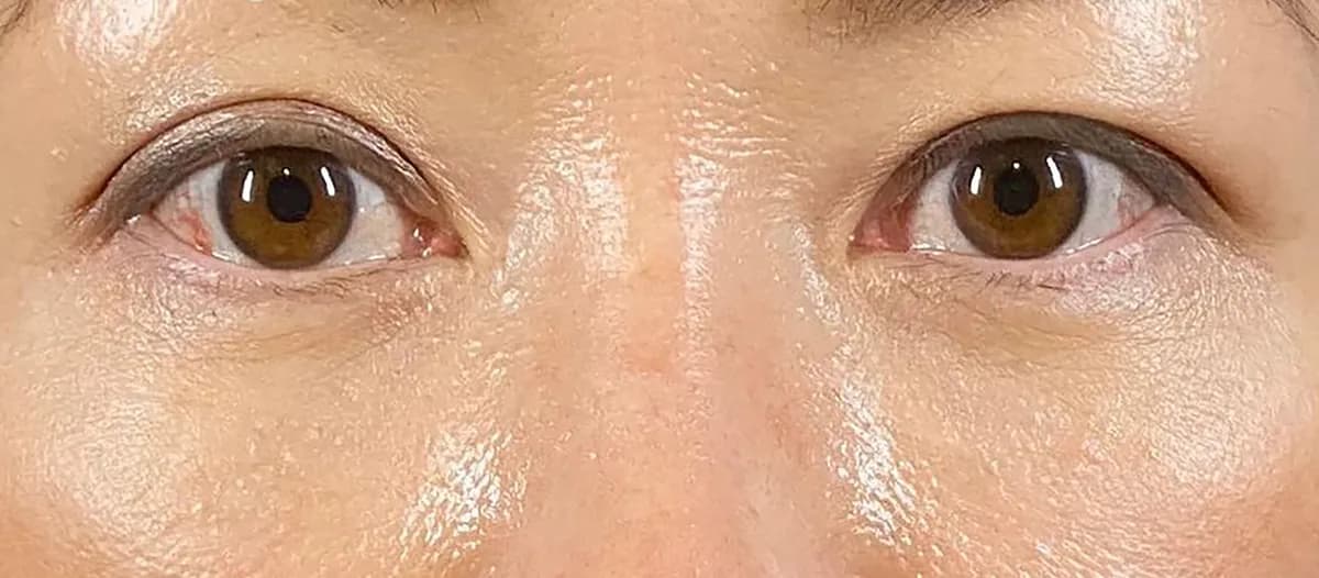Lower Eyelid Fat Removal Surgery After