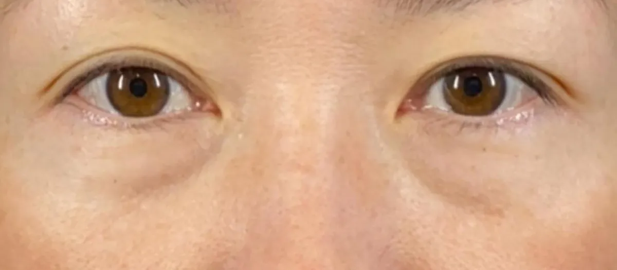Lower Eyelid Fat Removal Surgery Before