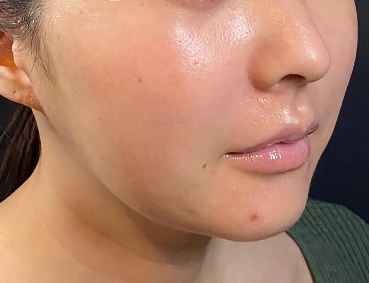 Tesslift Thread Lift After