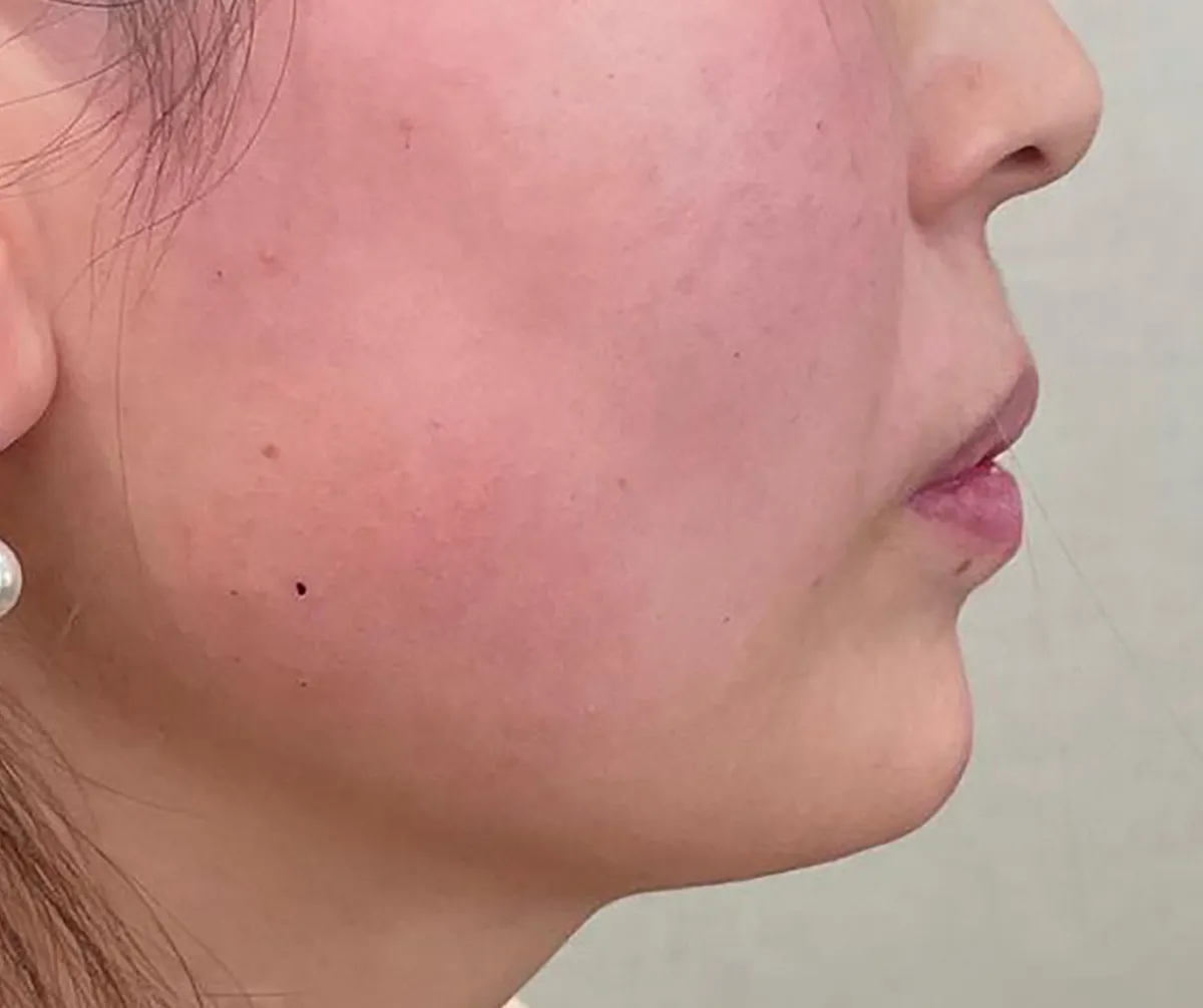 Jawline Contouring After