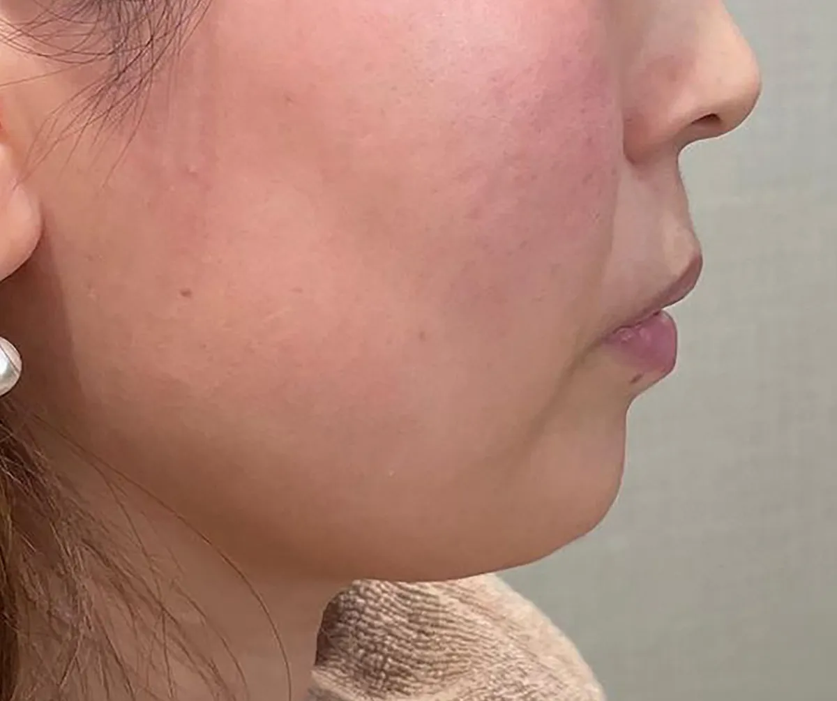 Jawline Contouring Before