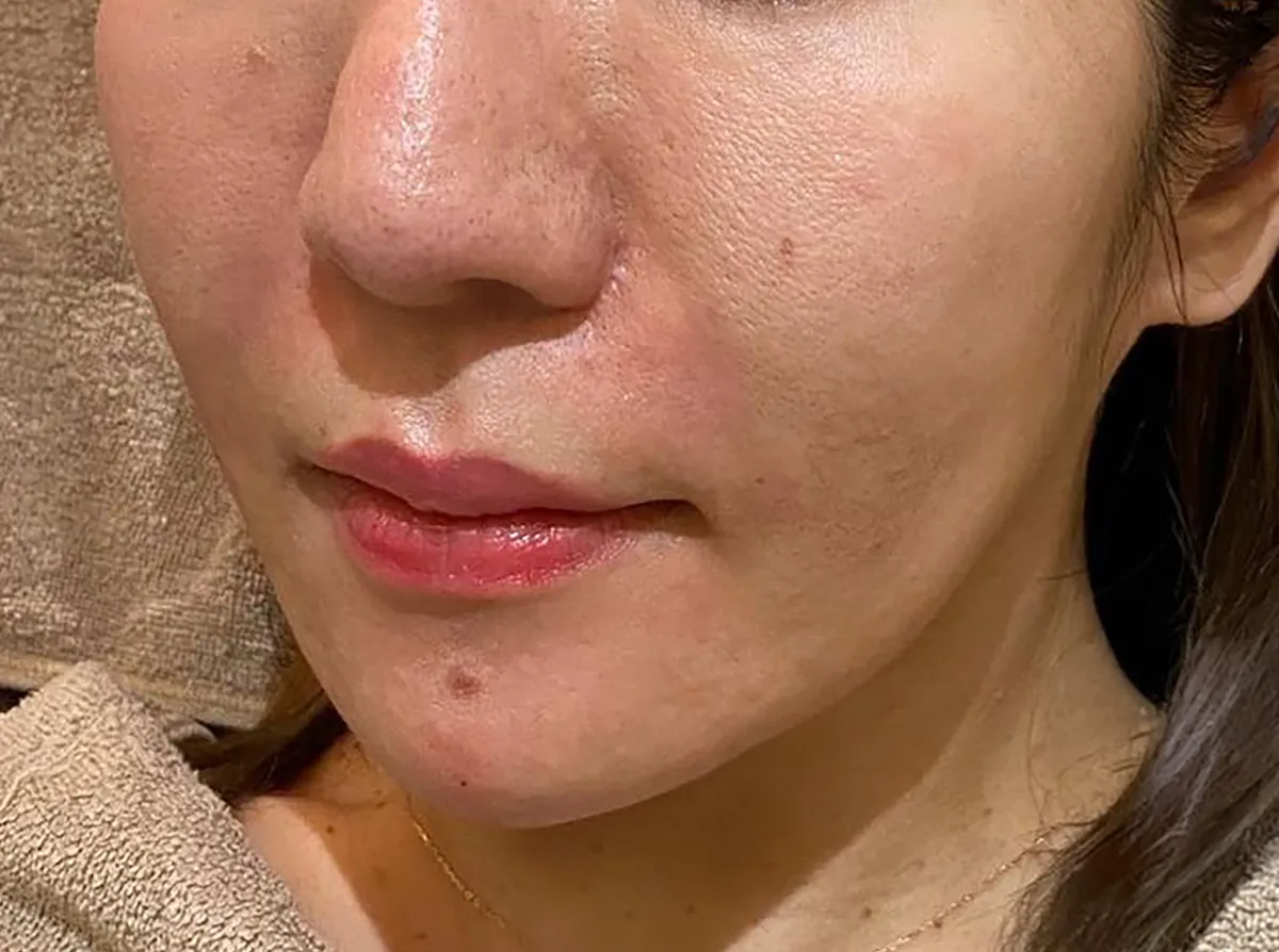 Nasolabial Folds / Chin Hyaluronic Acid Injection After