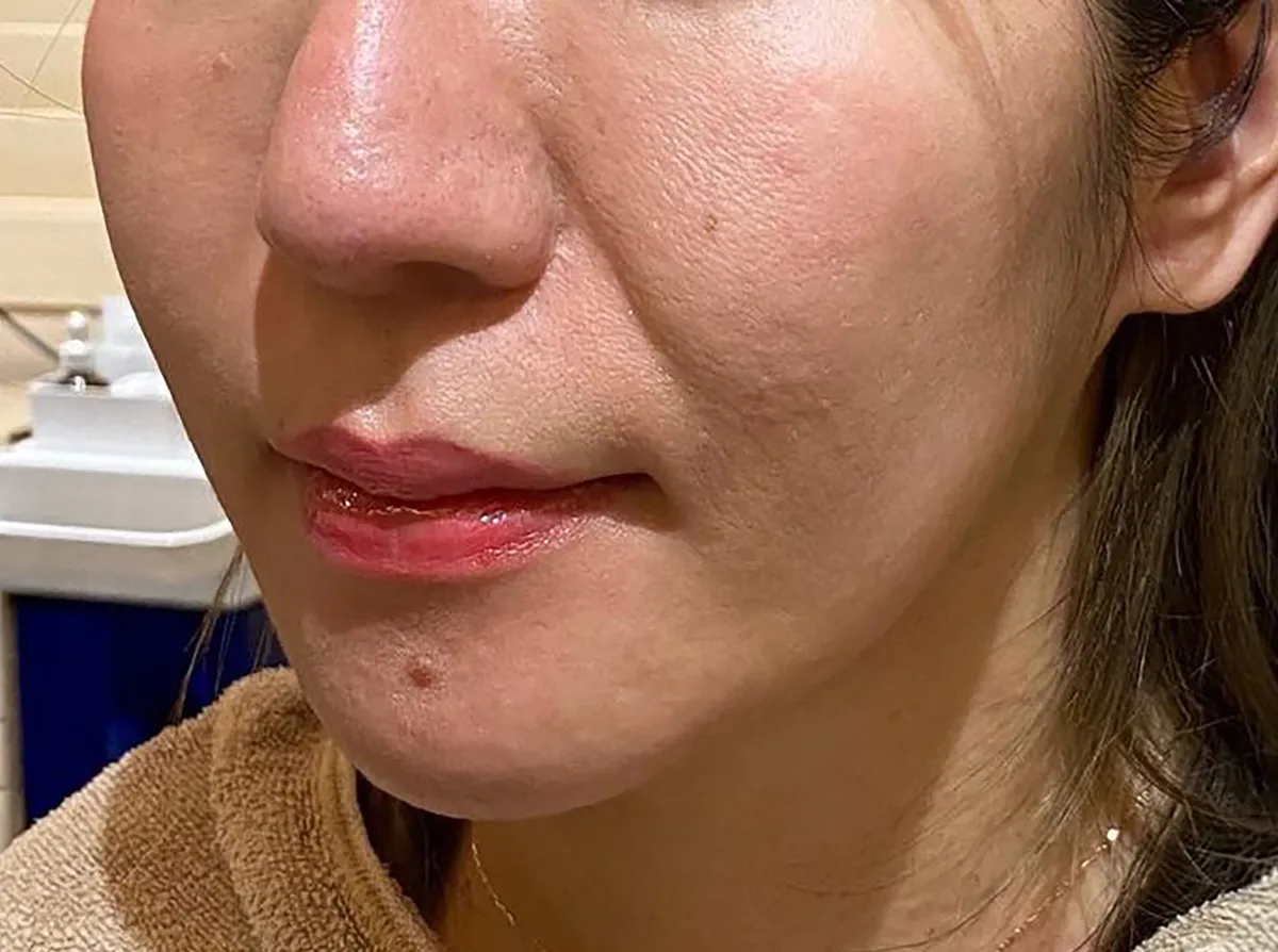 Nasolabial Folds / Chin Hyaluronic Acid Injection Before