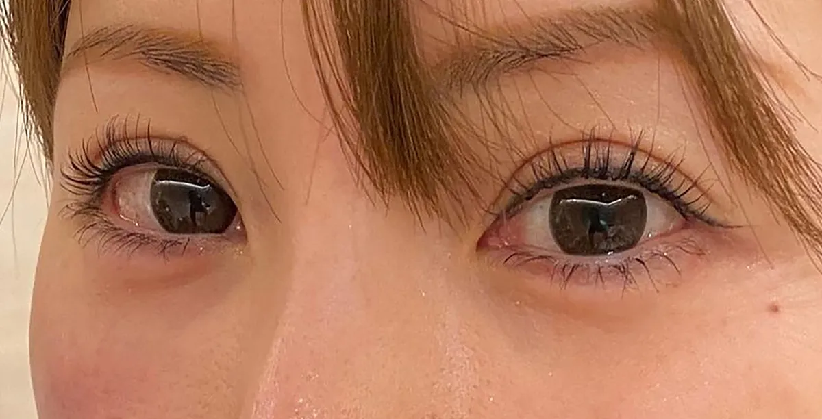Tear Trough Hyaluronic Acid After