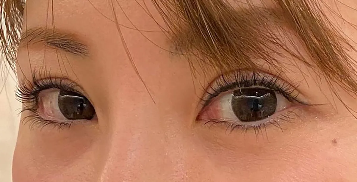 Tear Trough Hyaluronic Acid Before