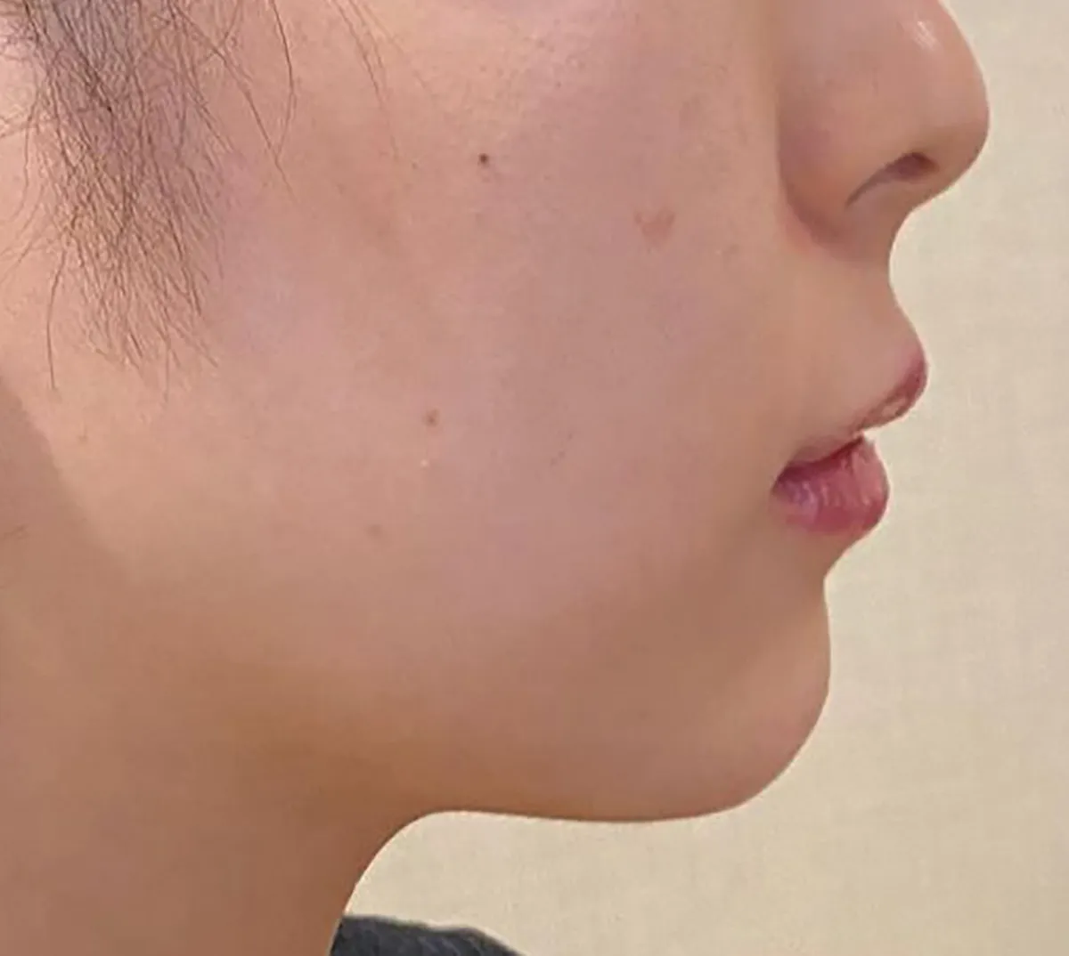 Philtrum Shortening / Chin 周りHyaluronic Acid Injection After