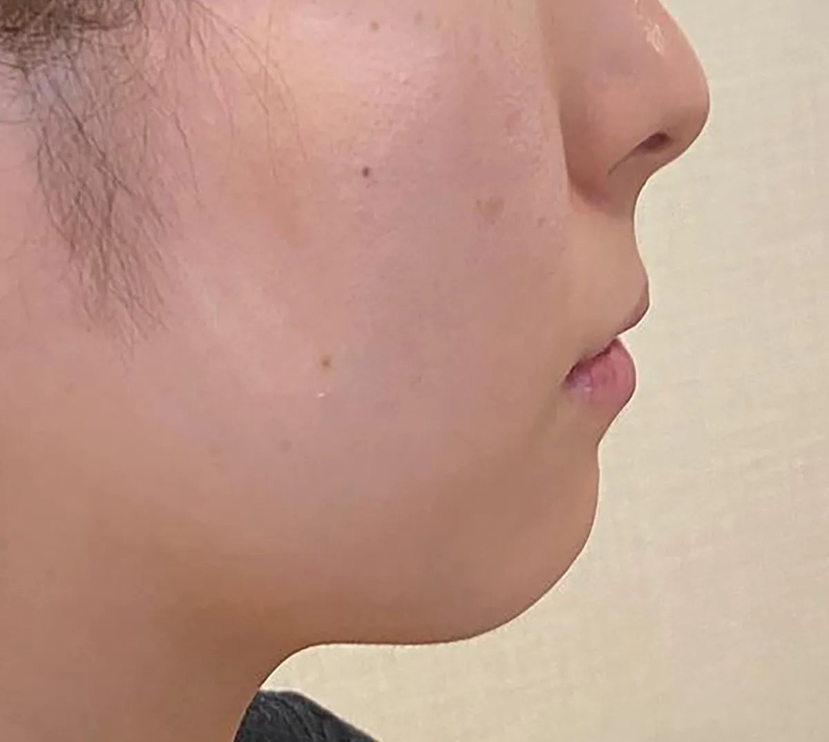 Philtrum Shortening / Chin 周りHyaluronic Acid Injection Before