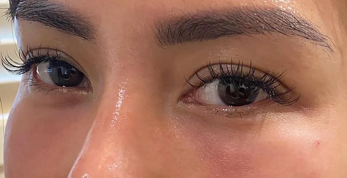 Under-Eye Baby Collagen Injection After