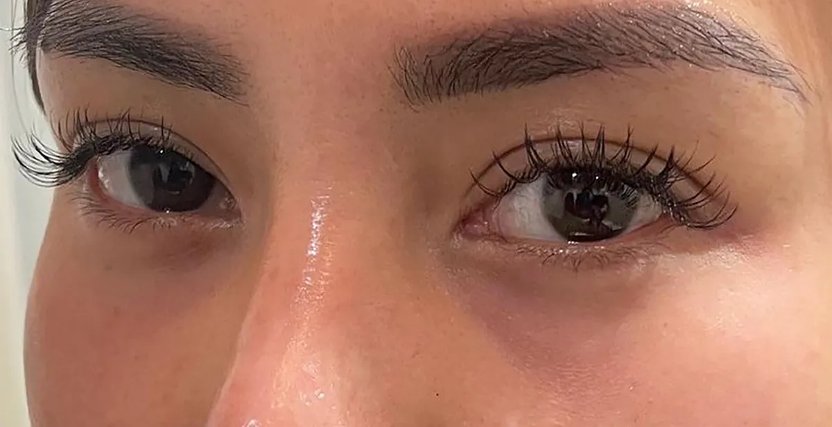 Under-Eye Baby Collagen Injection Before