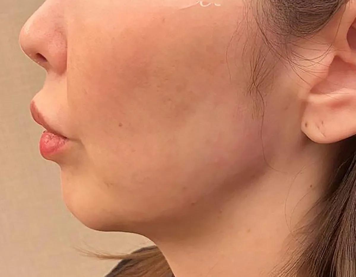 Jawline Contouring After
