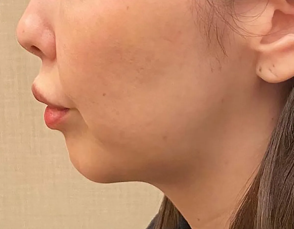 Jawline Contouring Before