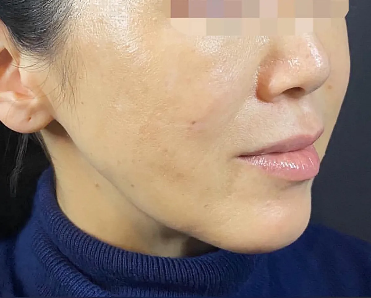 Combination Lift (HIFU + Thread) After