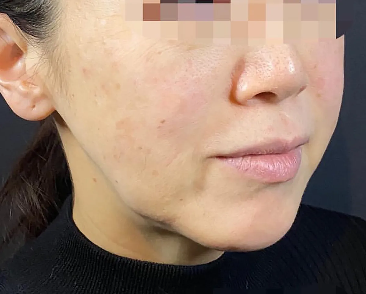 Combination Lift (HIFU + Thread) Before