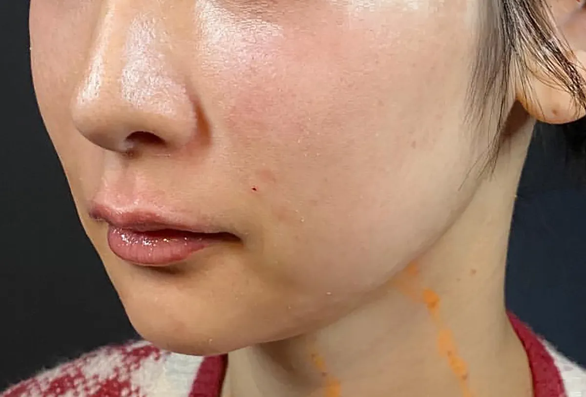 Jawline Contouring + Lips Hyaluronic Acid Injection After
