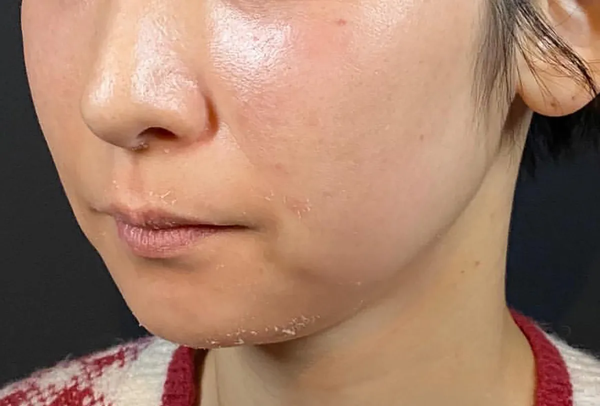 Jawline Contouring + Lips Hyaluronic Acid Injection Before