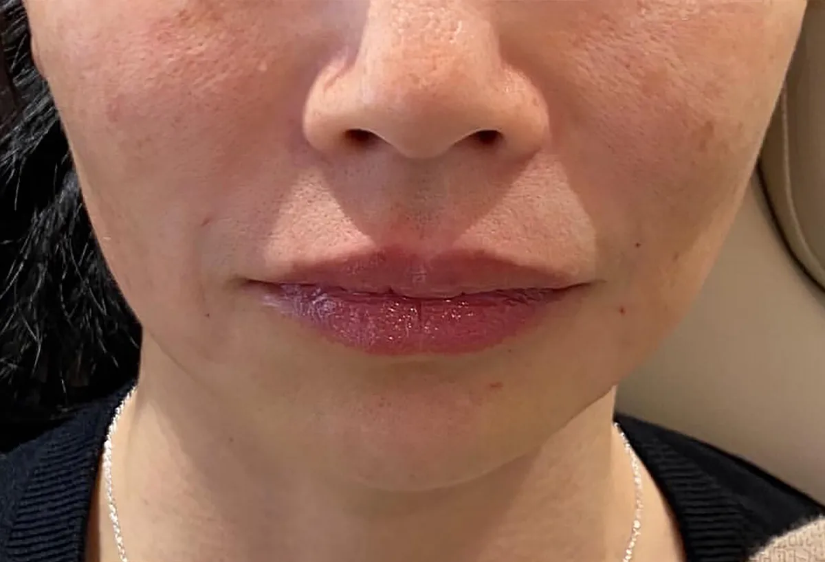 Lower Face Hyaluronic Acid Injection After