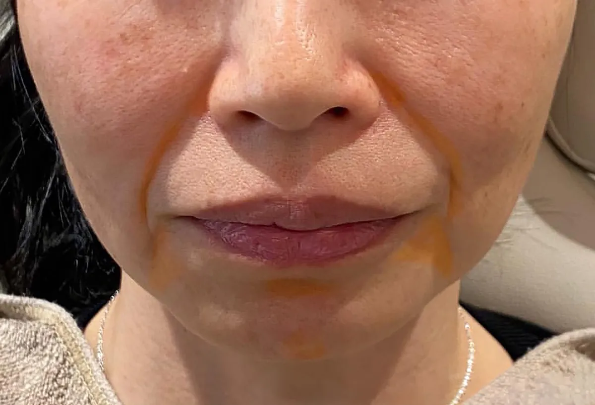 Lower Face Hyaluronic Acid Injection Before
